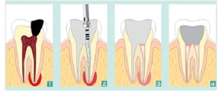 endodontdski postupak